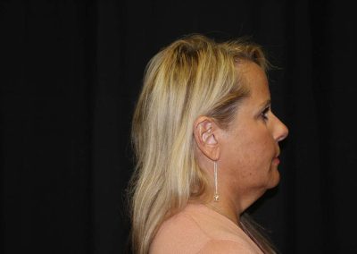 side view of woman before facelift surgery