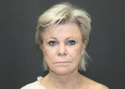 front view of woman before facelift surgery