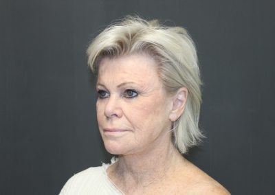 front view of woman before facelift surgery