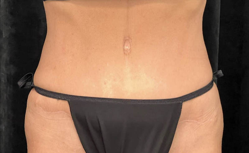 Tummy Tuck after