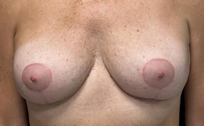 3 months after breast lift and implant removal